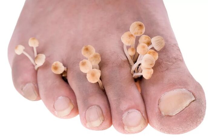 Leg fungus