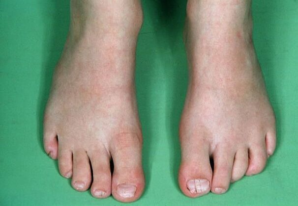 Leg fungus