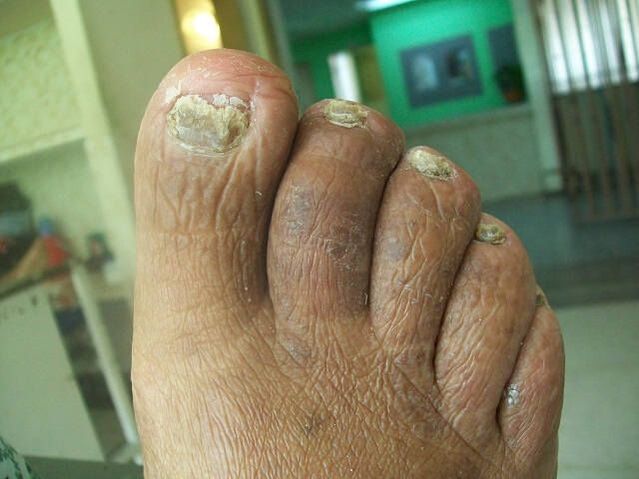 The lesion of the sponge