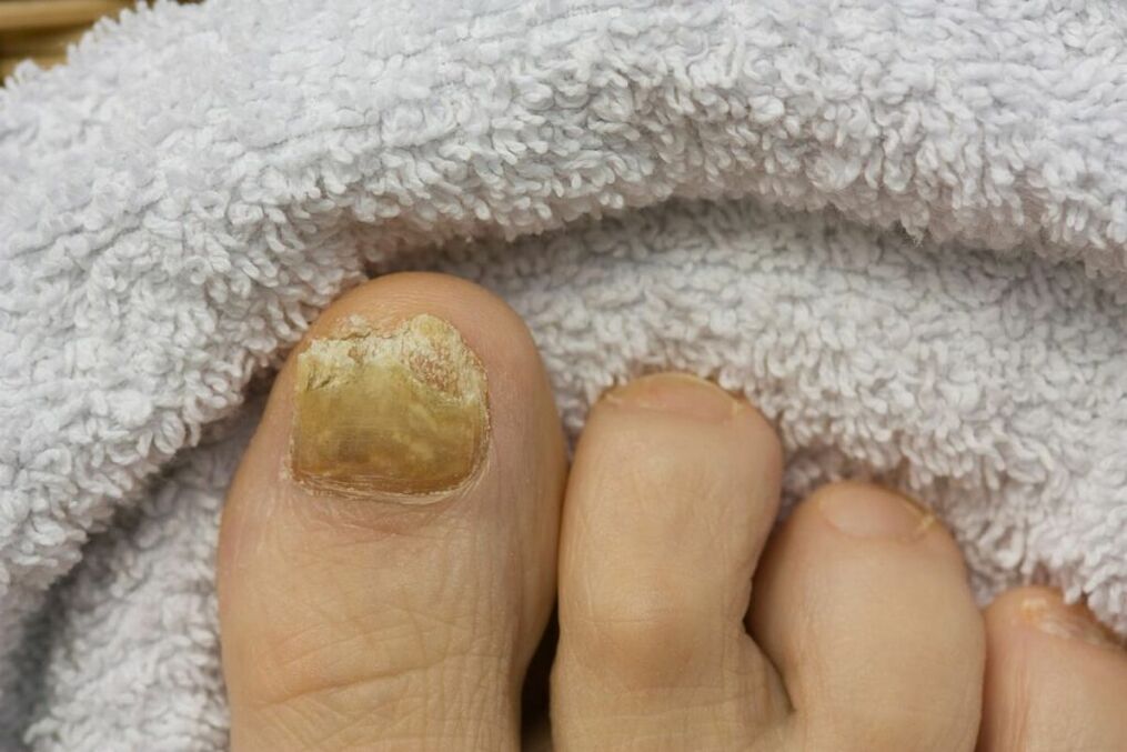 Atrophic stage of the fungus (falling pieces of the toenail)