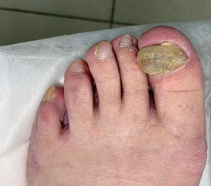 Hypertrophic onychomycosis of the foot - deformed nail