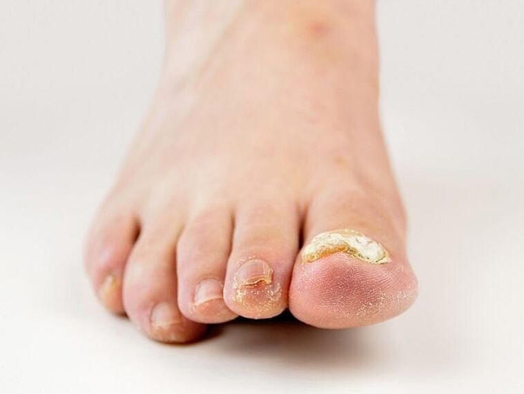 Thickening of the nail plate of the big toe with fungus