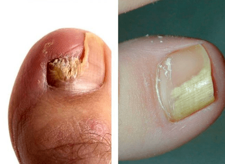 Fungal disease