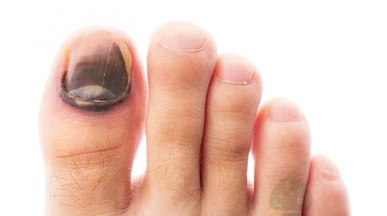 Stage of Running the disease with a fungus of the nail of the thumb