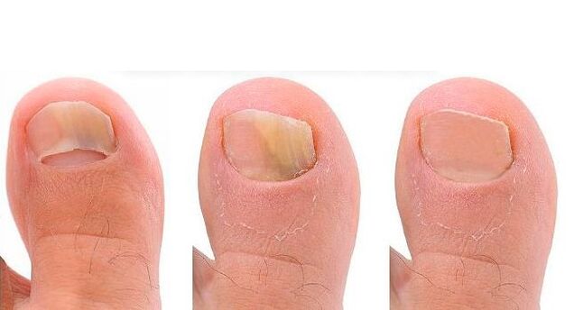 stages of toenail fungus development