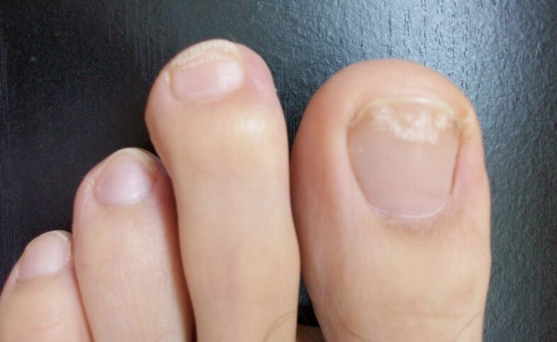The initial signs of fungus are a change in the color of the nail plate, the appearance of spots