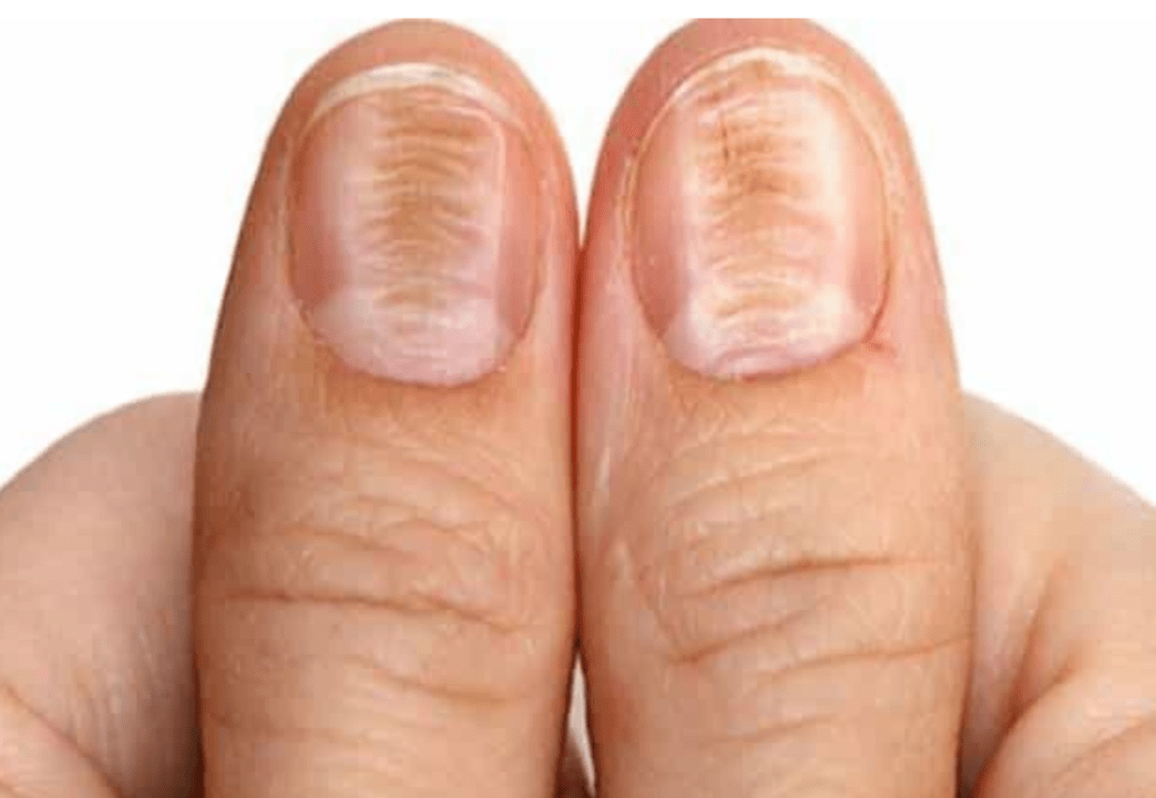 change in the color and structure of the nails