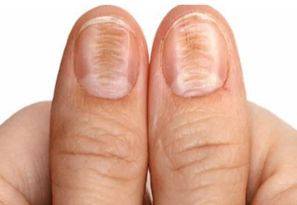 changes in the color and structure of the nails